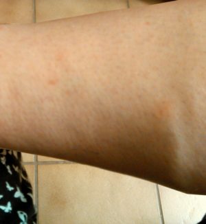 Milbenstiche am Bein